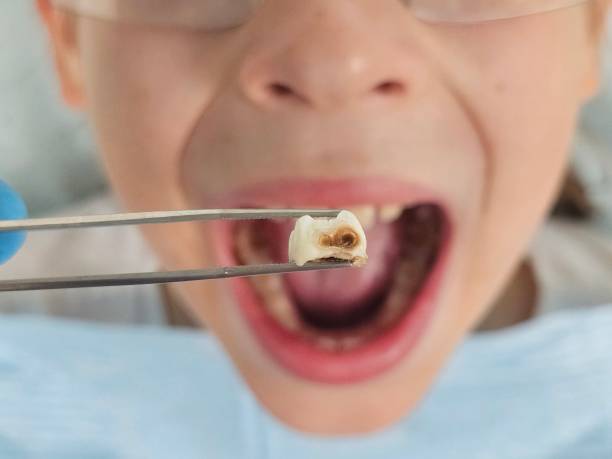 Best Emergency Dental Care for Broken or Chipped Teeth in South Bend, IN